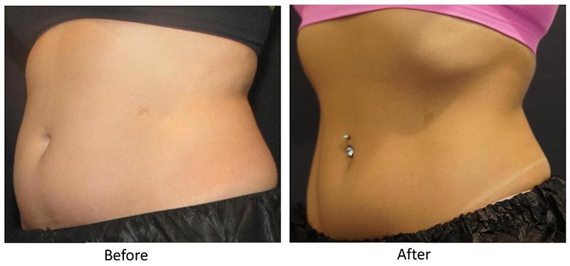 Before and After CoolSculpting®