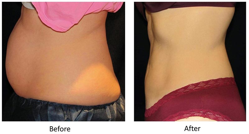Before and After CoolSculpting®