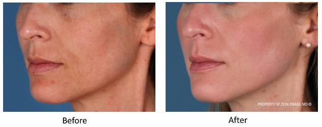 Chemical Peel before and after