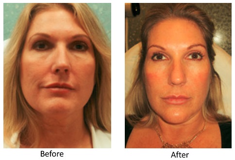 Injectables, Dermal Fillers Before and After