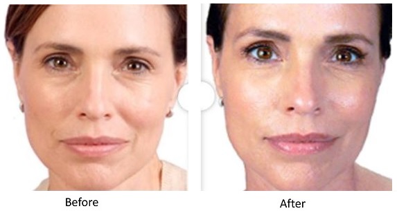 Juvederm before and after